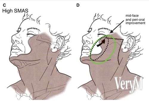 韓国のフェイシャルリフト専門病院