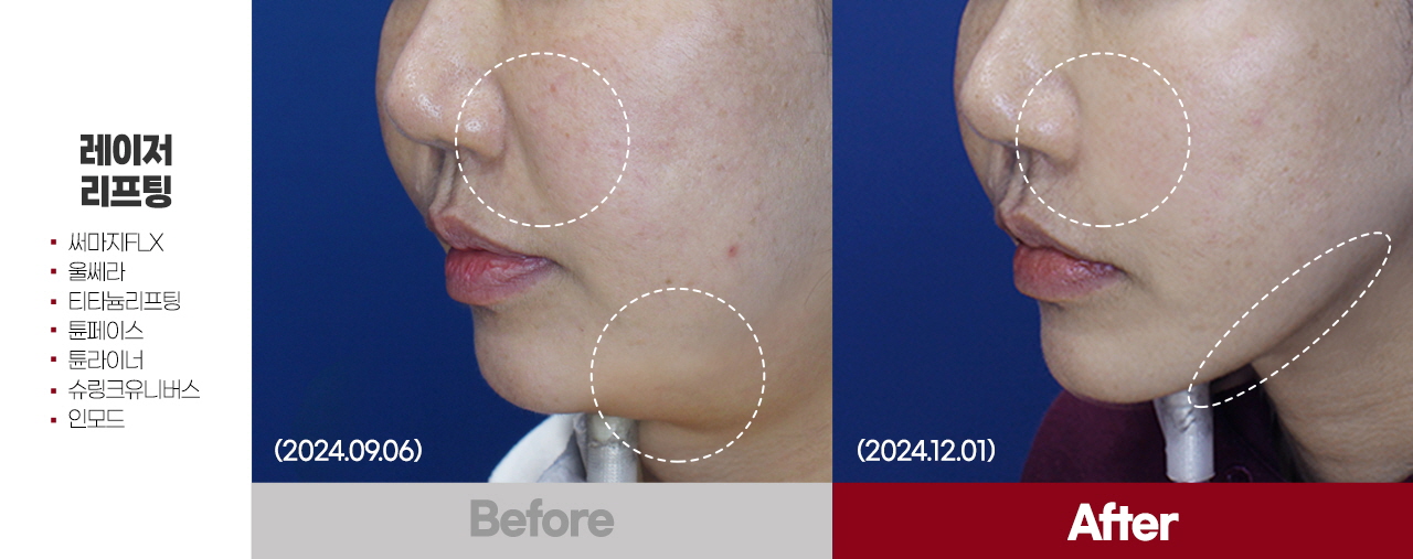 Madeu皮膚科麗珠蘭注射項目