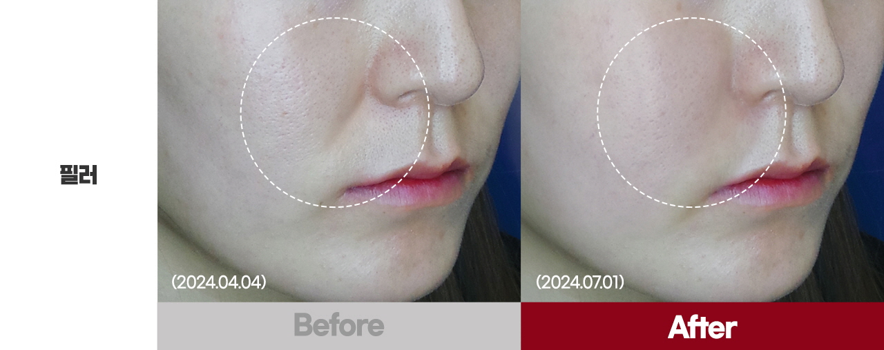 Madeu皮膚科填充注射項目