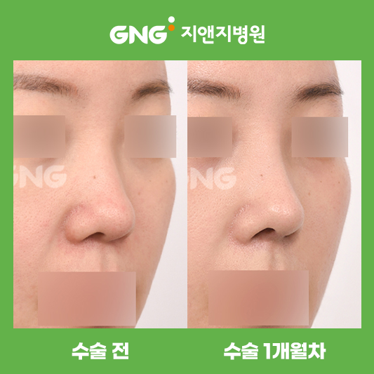 2026 韓國皮膚科院做鼻子好|首爾 5 家權威院所 鼻部整形推薦缩略图 2026 韓國皮膚科院做鼻子好|首爾 5 家權威院所 鼻部整形推薦缩略图