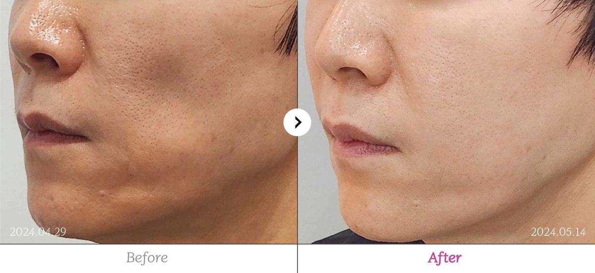 Reberry 皮膚科價格完全攻略|2026 江南水光、熱瑪吉、提升項目費用全公開插图6 Reberry皮膚科治療效果對比