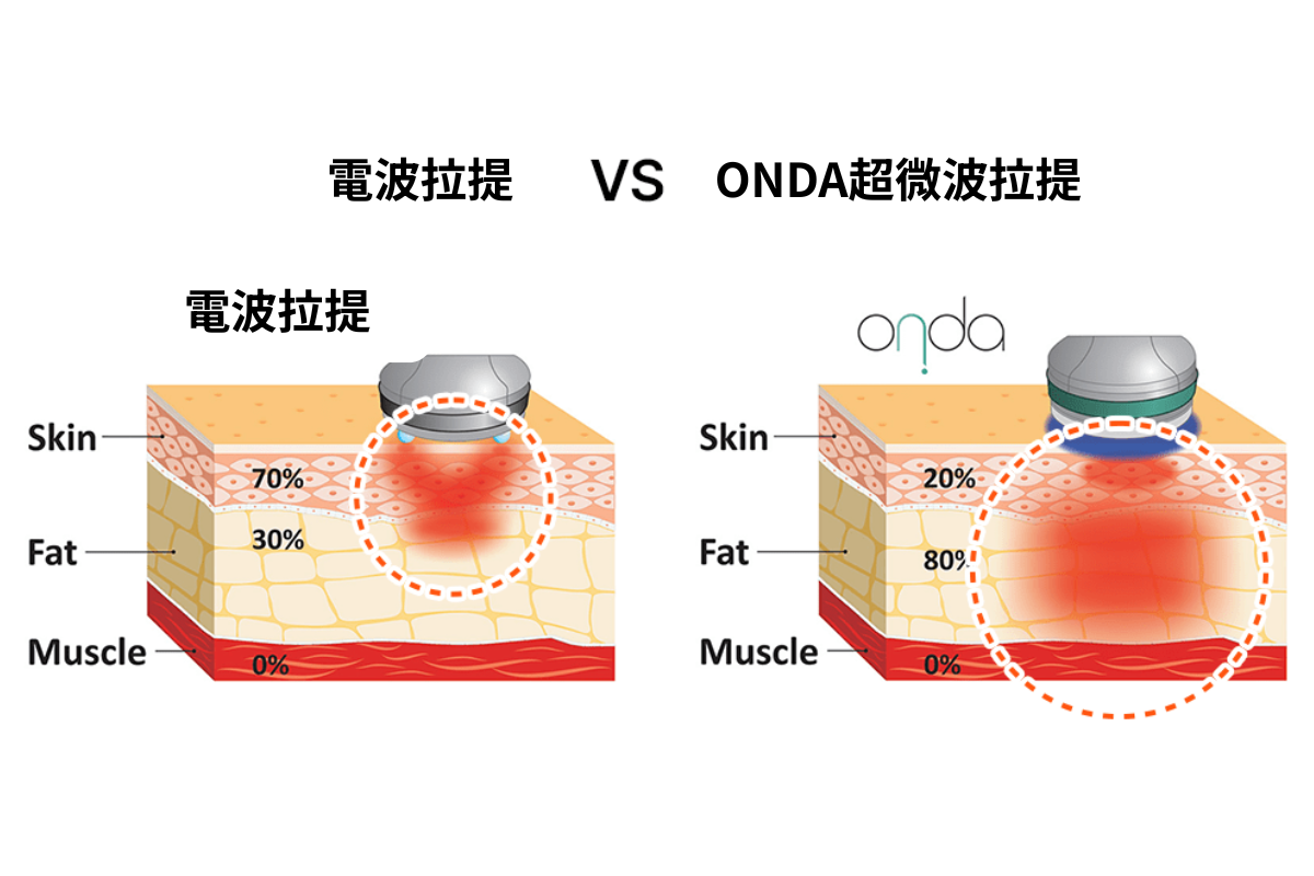 ONDA治療效果圖2
