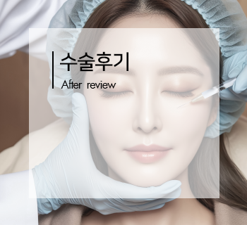 Teknik Pemulihan Mata oleh Klinik Pembedahan Kosmetik EVE di Korea Selatan | Adakah Masih Ada Harapan Jika Prosedur Pembuatan Kelopak Mata Ganda Gagal? Ujian Langsung oleh Dcard/PTT pada tahun 2026 - 韩国医美中心 Contoh kes pemulihan mata di Eve Plastic Surgery menunjukkan keberkesanan teknik jahitan pelapisan dalam mencapai hasil yang semula jadi.